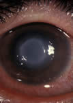 Eye inflammation
