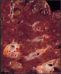 Section of liver damaged by HBV. Note the enlarged cells and blistering of the capsular surface.