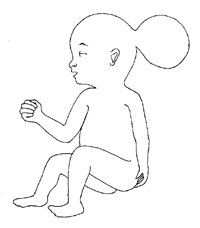 child with encephalocele