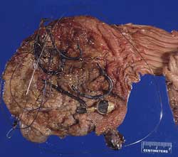 Pelican Stomach: Injested Objects: Brown pelican stomach with ingested jig head, hooks, and line. (USA)