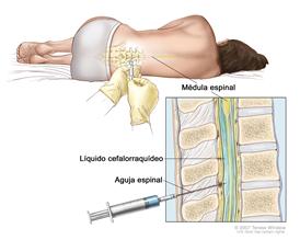 Punción lumbar; la imagen muestra a un paciente acostado sobre una camilla en posición encorvada y una aguja intrarraquídea o espinal, la cual es larga y fina, que se inserta en la parte inferior de la espalda. El recuadro muestra una vista de cerca de esta aguja insertada en el líquido cefalorraquídeo (LCR), en la parte inferior de la columna vertebral.