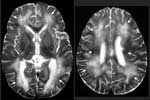 Figure 1. Biopsy-proven Baylisascaris procyonis encephalitis in a 13-month-old boy....