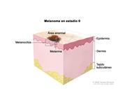 Melanoma en estadio 0; el dibujo muestra la anatomía de la piel con un área anormal en la superficie de esta. Se muestra la epidermis (capa exterior de la piel) con melanocitos y melanina normales y anormales. También se muestra la dermis (capa interna de la piel) y el tejido subcutáneo bajo la dermis.