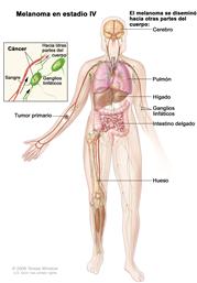 Melanoma en estadio IV; el dibujo muestra que el tumor primario se ha diseminado hacia otras partes del cuerpo, como el cerebro, el pulmón, el hígado, los ganglios linfáticos, el intestino delgado o los huesos. La ampliación muestra el cáncer en los ganglios linfáticos, los vasos linfáticos y los vasos sanguíneos.