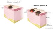 Dibujo de dos paneles del melanoma en estadio I. El primer panel muestra un tumor en estadio IA que no mide más de 1 mm de grosor, sin úlcera (rotura de la piel). El segundo panel muestra dos tumores en estadio IB. Un tumor no mide más de 1 mm de grosor, con úlcera y el otro tumor mide más de 1 mm pero no más de 2 mm de grosor, sin úlcera. También se muestra la epidermis (capa exterior de la piel), la dermis (capa interna de la piel) y el tejido subcutáneo debajo de la dermis.