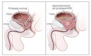 Un dibujo en dos paneles muestra la anatomía reproductora y urinaria normal así como hiperplasia prostática benigna (HPB).  El panel de la izquierda muestra la próstata normal y el flujo de orina de la vejiga a la uretra.  El panel de la derecha muestra un agrandamiento de próstata que ejerce presión sobre la vejiga y la uretra, con la obstrucción del flujo de la orina.