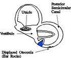 Drawing of displaced calcium stones in the inner ear. - Click to enlarge in new window.