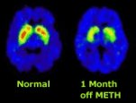 This photo of the brain of a meth user may look complicated. But the conclusions are easy to understand. This image shows that after a long period of abstinence from methamphetamine