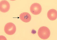 Blood smear from Tom Miller during his illness, showing several red blood cells, one of which (arrow) is infected by a malaria parasite