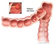 Pólipos del colon; muestra dos pólipos (uno plano y otro pedunculado) en el interior del colon. El recuadro interior muestra imagen de un pólipo pedunculado.