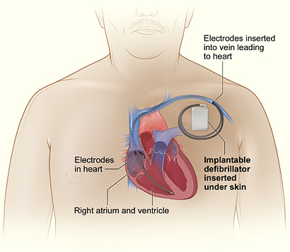 The illustration shows the location of an implantable cardioverter defibrillator in the upper chest.