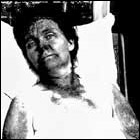 Photo: Woman suffering from pellagra
