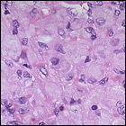 Enlarged cells in the spleen of a person with Gaucher Disease