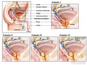 Estadificación del cáncer de la próstata; el dibujo en cinco paneles muestra una vista lateral de la anatomía masculina normal y vistas en primer plano que muestran como se extiende el cáncer en sus estadios I, II, III y IV desde la próstata, al tejido circundante y luego a los ganglios linfáticos u otras partes del cuerpo.