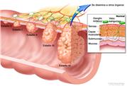 Estadificación del cáncer del colon; muestra penetración del tumor a través de las capas del colon con cáncer en estadios 0, I, II, III y IV. El recuadro interior muestra serosa, músculos, submucosa y las capas de mucosa de la pared del colon, ganglios linfáticos y vasos linfáticos.