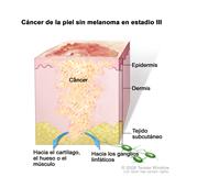 Cáncer de la piel sin melanoma en estadio III; el dibujo muestra un tumor que se ha diseminado desde la epidermis (capa externa de la piel) y la dermis (capa interna de la piel) hacia el tejido subcutáneo y hacia el cartílago, el hueso o el músculo debajo de la piel o hacia los ganglios linfáticos cercanos.