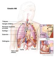 Cáncer de pulmón de células no pequeñas en estadio IIIB. El dibujo muestra el cáncer en los ganglios linfáticos, encima de la clavícula o los ganglios linfáticos del lado opuesto del pecho en que está el cáncer; también muestra el cáncer en la tráquea, el bronquio izquierdo principal, el esófago, el esternón, el diafragma, la vena cava inferior, la aorta, el corazón y la pared torácica. Un recuadro muestra una ampliación de la diseminación del cáncer desde el pulmón hacia el interior de la pleura y la pared torácica. Otro recuadro muestra una ampliación del cáncer que se disemina desde el pulmón hacia el  pericardio (la membrana que rodea el corazón) y el corazón.