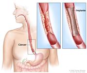 Implante esofágico. Muestra como el cáncer bloquea el esófago. El recuadro muestra una imagen ampliada del cáncer y el implante colocado en el esófago para mantenerlo abierto.