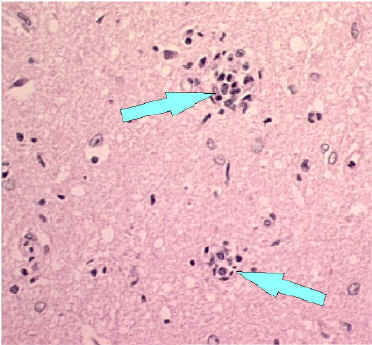 Babes nodules