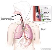 Biopsia por aspiración con aguja fina guiada por ecografía endoscópica; el dibujo muestra un endoscopio con una sonda ecográfica y una aguja de biopsia insertada a través de la boca hasta el esófago. El dibujo también muestra los ganglios linfáticos cerca del esófago y el cáncer en un pulmón. El dibujo del recuadro muestra la sonda ecográfica localizando los ganglios linfáticos con el cáncer y la aguja de biopsia extrayendo tejido de uno de los ganglios linfáticos cerca del esófago.