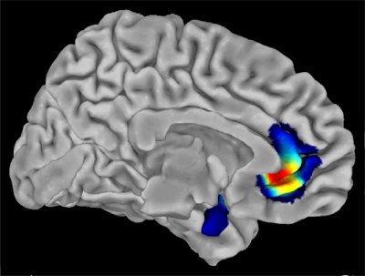 gray matter volume differences