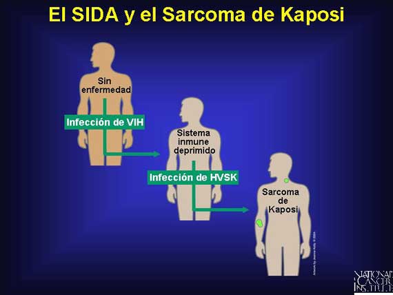 El SIDA y el Sarcoma de Kaposi
