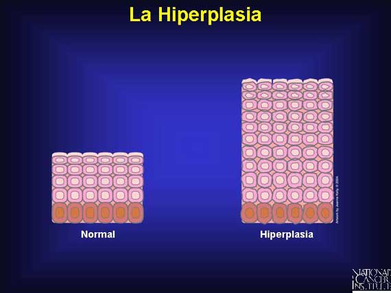 La Hiperplasia