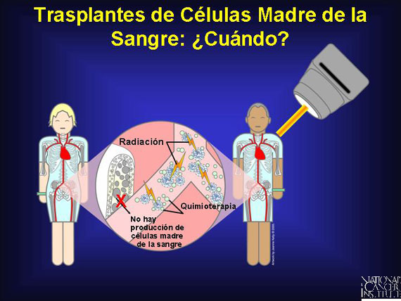 Trasplantes de Células Madre de la Sangre: ¿Cuándo?