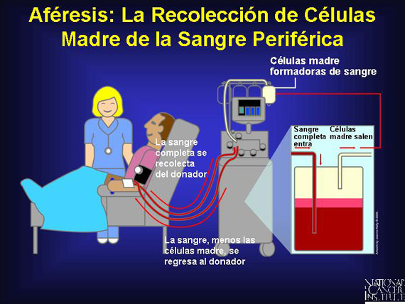 Aféresis: La Recolección de Células Madre de la Sangre Periférica