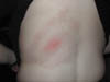 Dermatlas: Back - Lyme Disease 