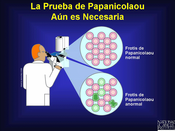 La Prueba de Papanicolaou .Aún es Necesaria