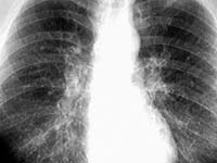 Normal chest x-ray