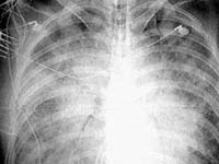 Chest x-ray of pateint with Hantavirus Pulmonary Syndrome