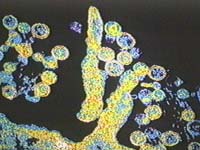 Virus infected cells seen under microscope