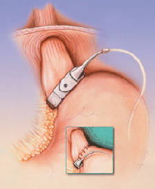 Intragastric Implant for Morbid Obesity