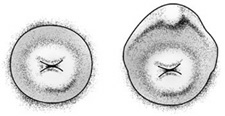 Image of a normal cervix, and one with a 'hood'