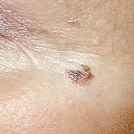 Melanoma is the least common form of skin cancer, but it causes the majority of skin cancer deaths. It starts as a tiny mole that, within months, begins growing.