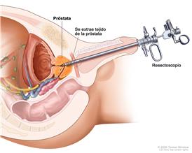 Resección transuretral de la próstata; el dibujo muestra la extracción de tejido de la próstata mediante un resectoscopio (tubo delgado con iluminación con un instrumento cortante en su extremo) que se inserta a través de la uretra.