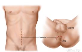 Un dibujo con dos paneles muestra dos formas de hacer una prostatectomía radical; en el primer panel, la línea de puntos muestra el lugar donde se hace la incisión a través de la pared del abdomen para realizar una prostatectomía retropúbica; en el segundo panel, la línea de puntos muestra el lugar donde se hace la incisión entre el escroto y el ano para realizar una prostatectomía perineal.