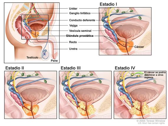 Estadificación del cáncer de la próstata; el dibujo en cinco paneles muestra una vista lateral de la anatomía masculina normal y vistas en primer plano que muestran como se extiende el cáncer en sus estadios I, II, III y IV desde la próstata, al tejido circundante y luego a los ganglios linfáticos u otras partes del cuerpo.
