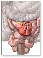 Intestinal anastomosis