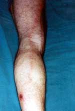 Figure. Lymphangitis expanding from the inoculation eschar on the left leg to an enlarged, painful lymph node on the left groin of a patient with Rickettsia mongolotimonae infection.
