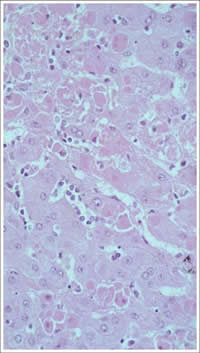 IHC of liver from fatal case of Lassa Fever.