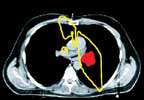 Planned radiation treatment