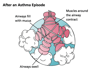 illustration of an area of the lung after an asthma episode as the airways swell and fill with mucus