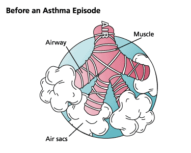 illustration of an area of the lung before an asthma episode showing the airways, muscle, and air sacs