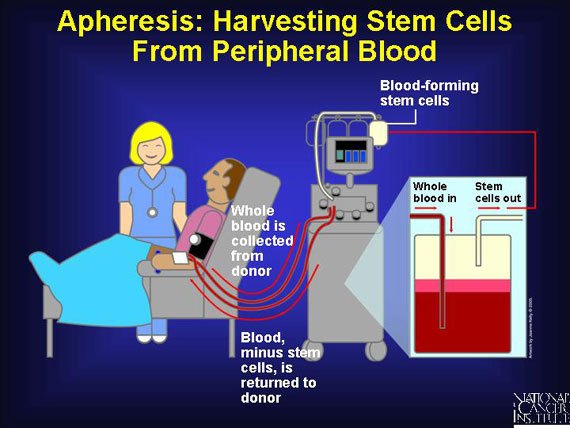Apheresis: Harvesting Stem Cells From Peripheral Blood