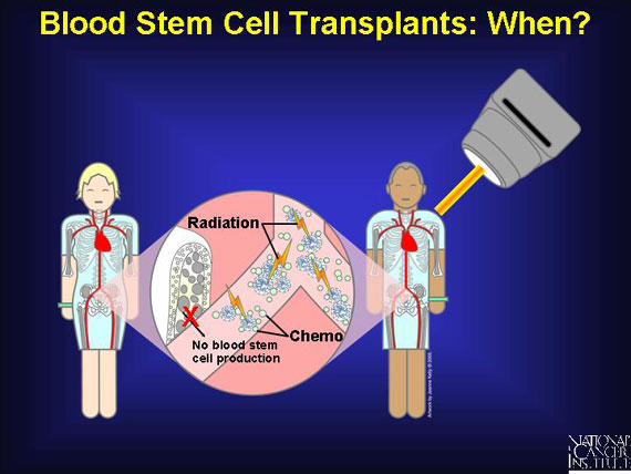 Blood Stem Cell Transplants: When?
