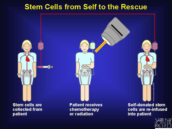 Stem Cells from Self to the Rescue