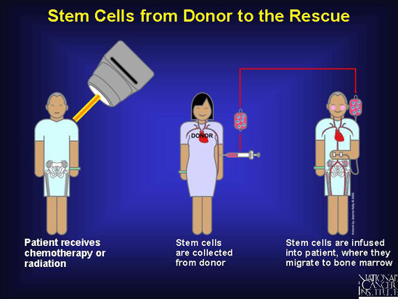 Stem Cells from Donor to the Rescue